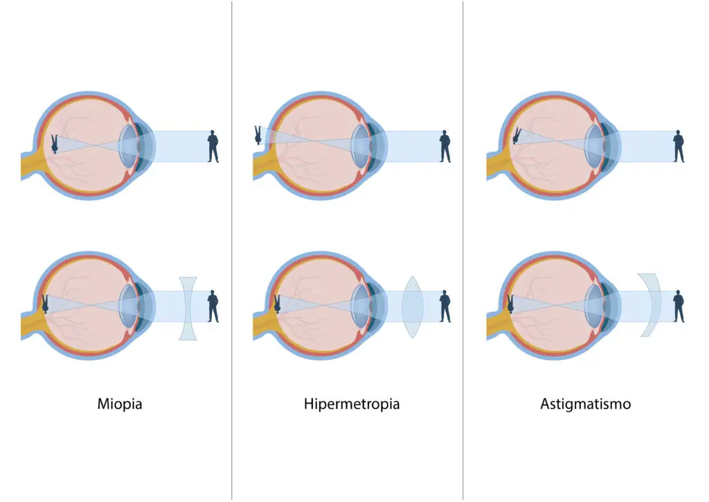 Tipos de Erros Refrativos - Miopia, hipermetropia, astigmatismo