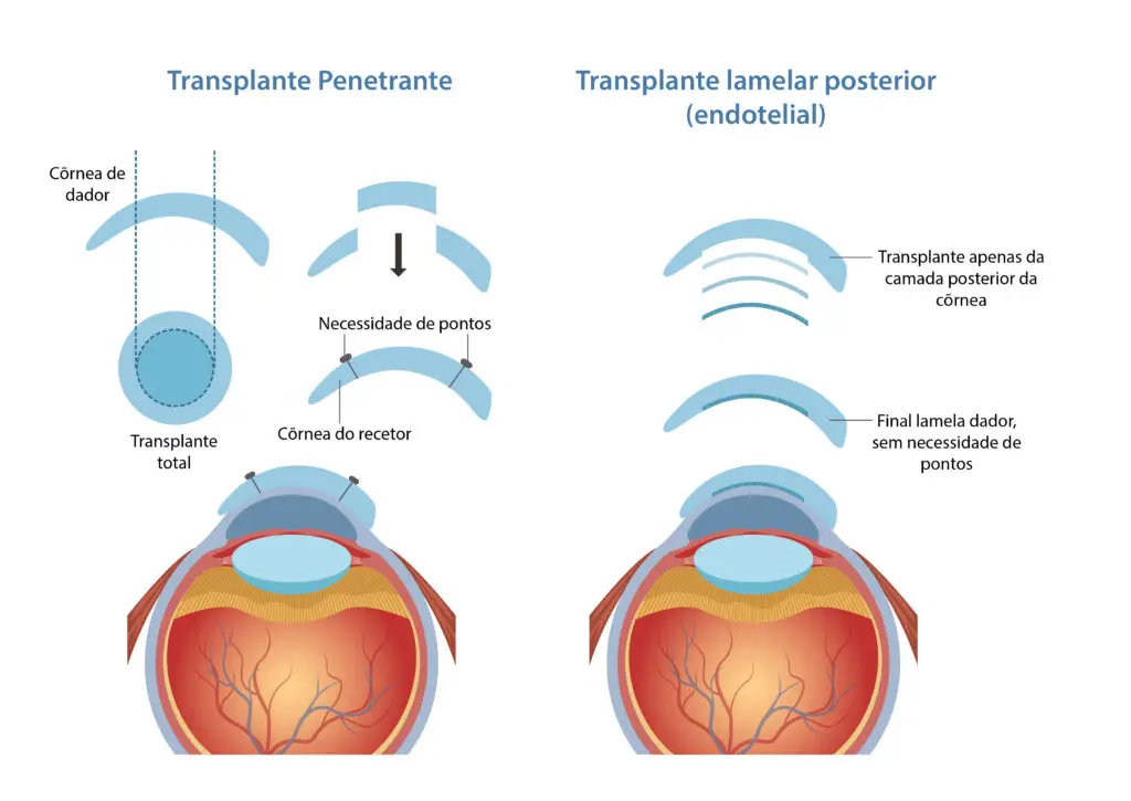 Tipos de transplante de córnea - Transplante penetrante e lamelar posterior