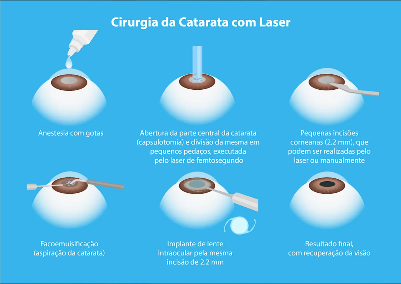 Cirurgia de Catarata com Laser