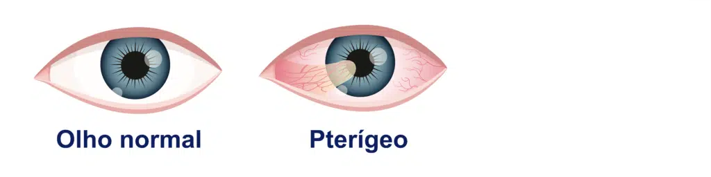 pterígeo pterígio