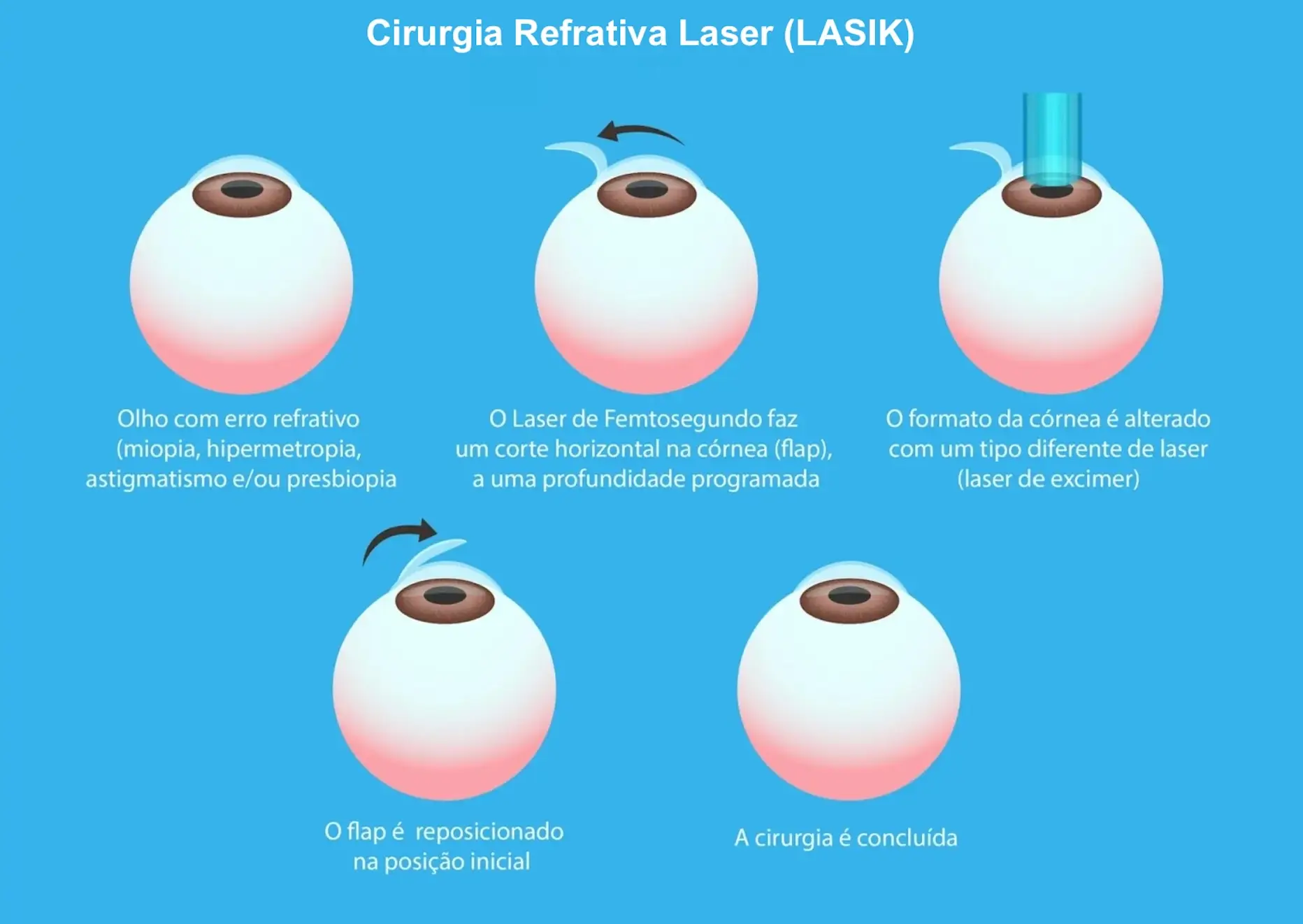 Imagem ilustrativa dos passos executados durante a cirurgia refrativa laser com a técnica LASIK assistido por laser de Femtosegundo