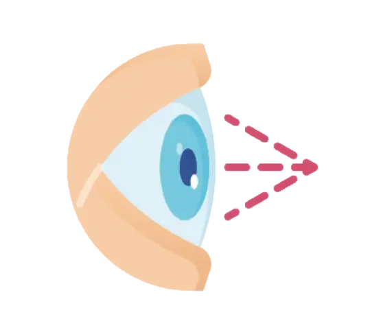 Cirurgia De Córnea